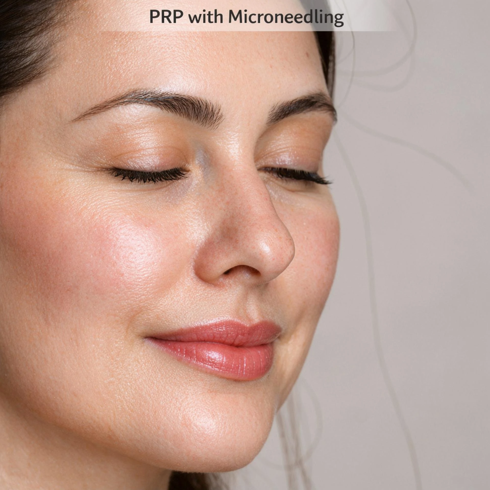 PRP with Microneedling: A Natural Approach to Skin Rejuvenation and Repair