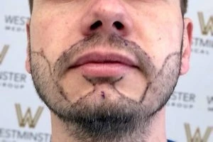 Beard Transplant London: Transforming Patchy Beards