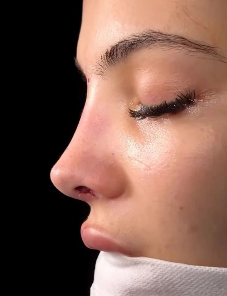 Can Rhinoplasty in Dubai Correct a Bulbous or Wide Nasal Tip?