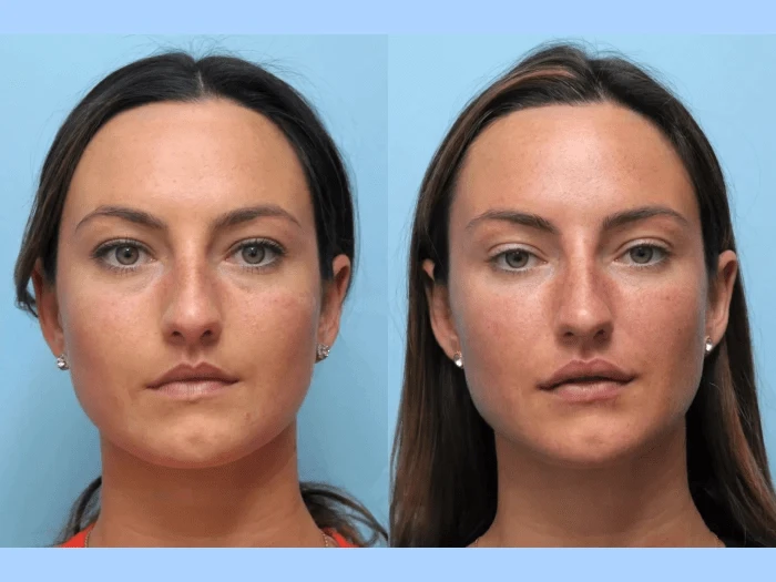 Thread lift Treatments in Dubai as a Minimally Invasive Procedure