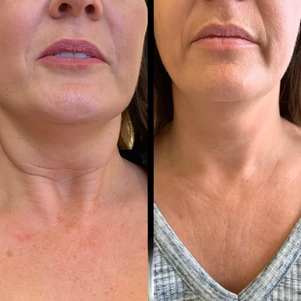 Best Aesthetic Clinic in Dubai for Customized Profhilo Protocols
