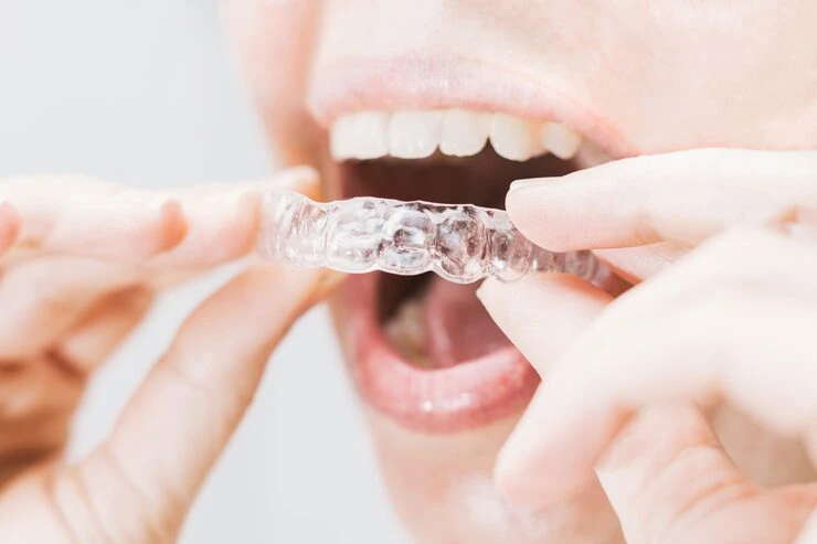 From Start to Finish: How Long Do Braces Take in New York?