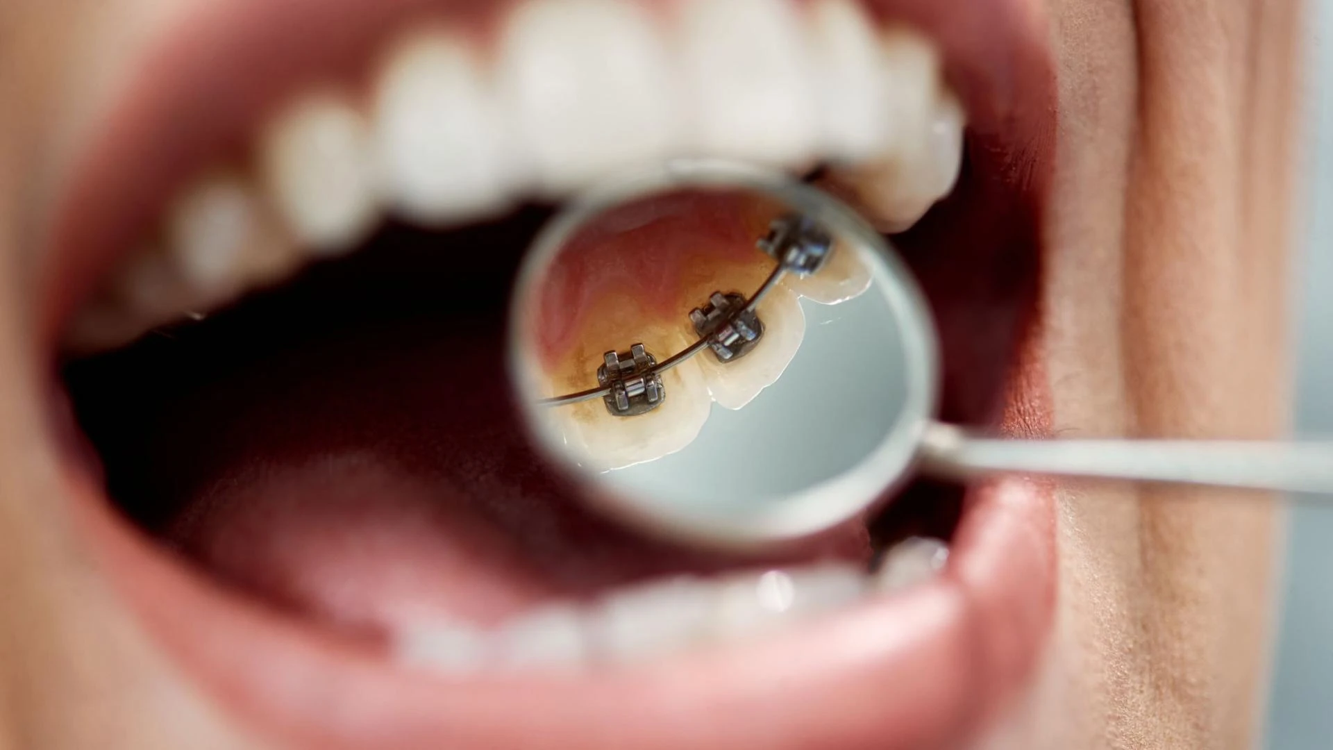 Want Straighter Teeth Without Visible Braces? Discover Lingual Braces in Garden Grove