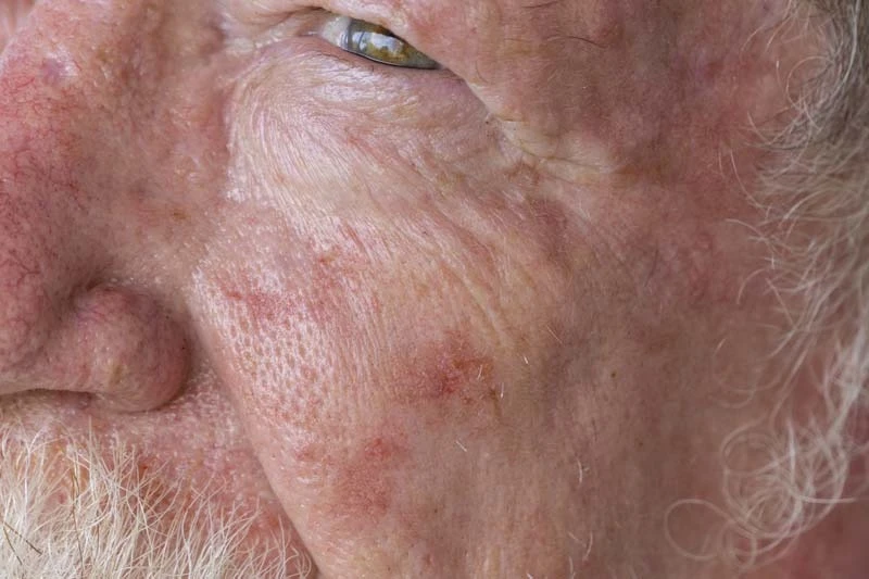 Best Dermatology Fort Worth: Trusted Dermatologist Saginaw for Skin Cancer Treatment