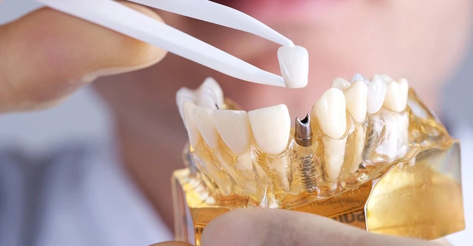 Dental Implant Services: From Optimal Design to Cost-Effectiveness