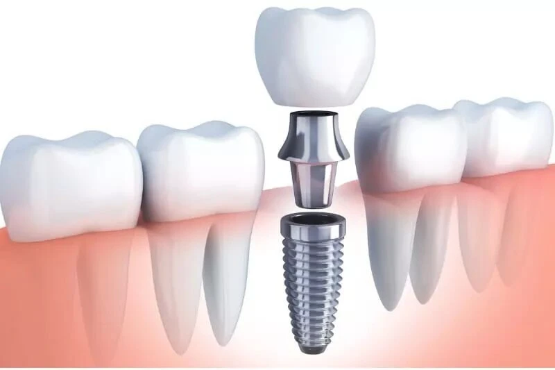 London's Finest Dental Implant Option: A Comprehensive Review