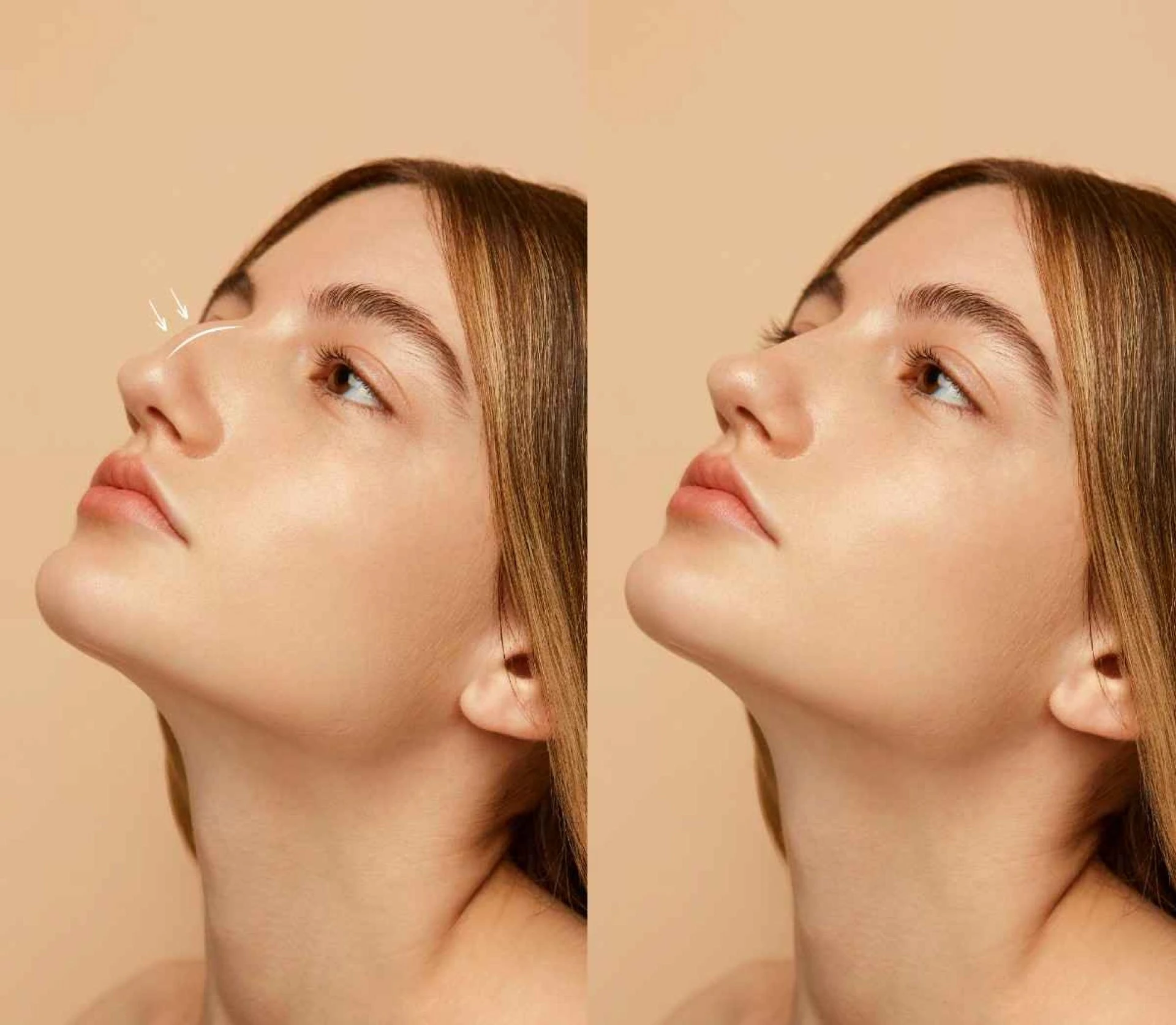 Is Rhinoplasty Permanent? Understanding Long-Term Results