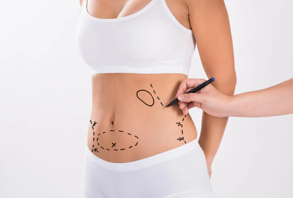 Proven Body Sculpt by Best Liposuction Doctors in Dubai