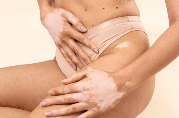 Management of Vitiligo Beyond Symptoms: The Depth of Homeopathy