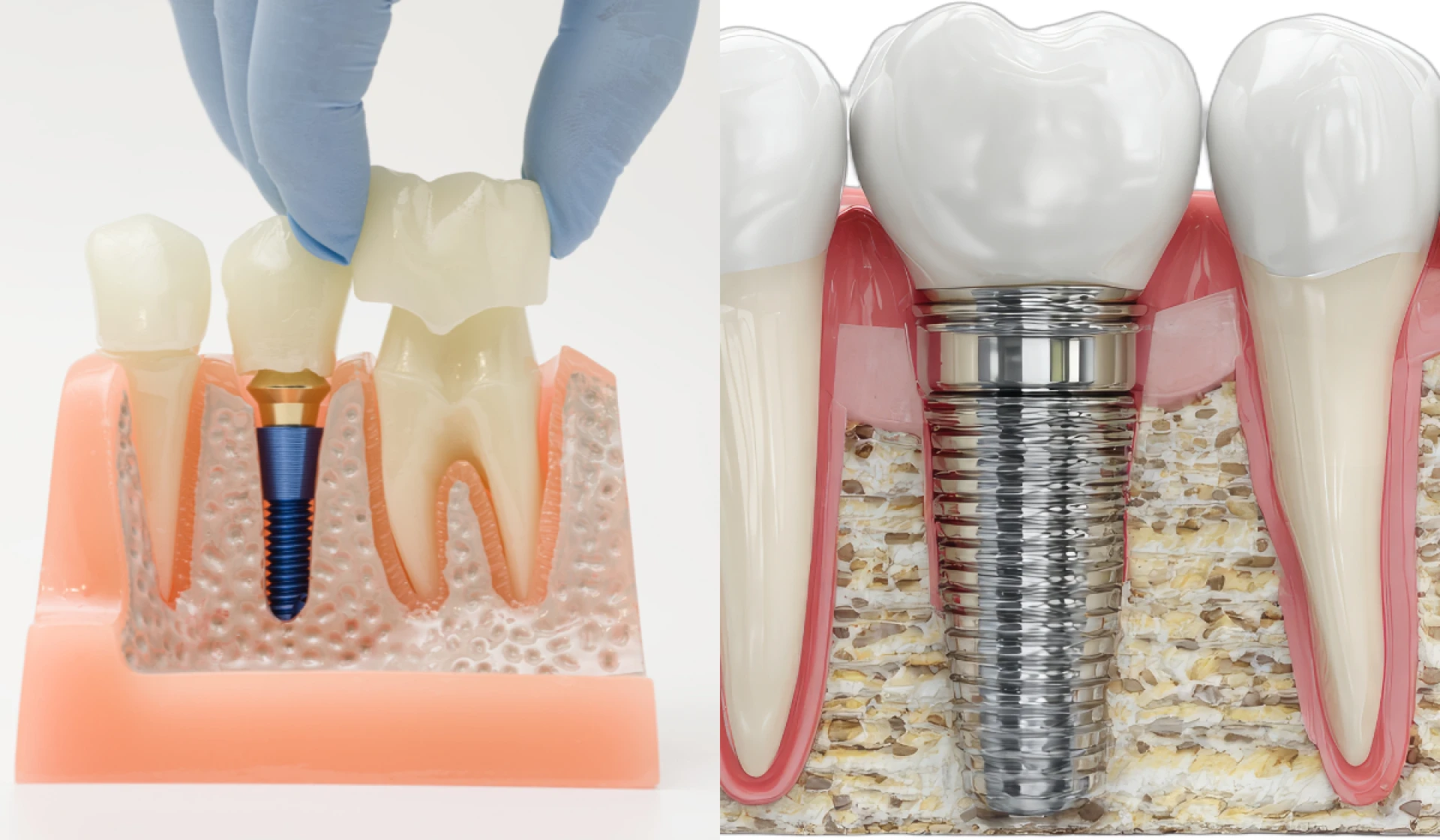 Dental Implants Treatment in Lahore Complete Smile Solution Book an Appointment