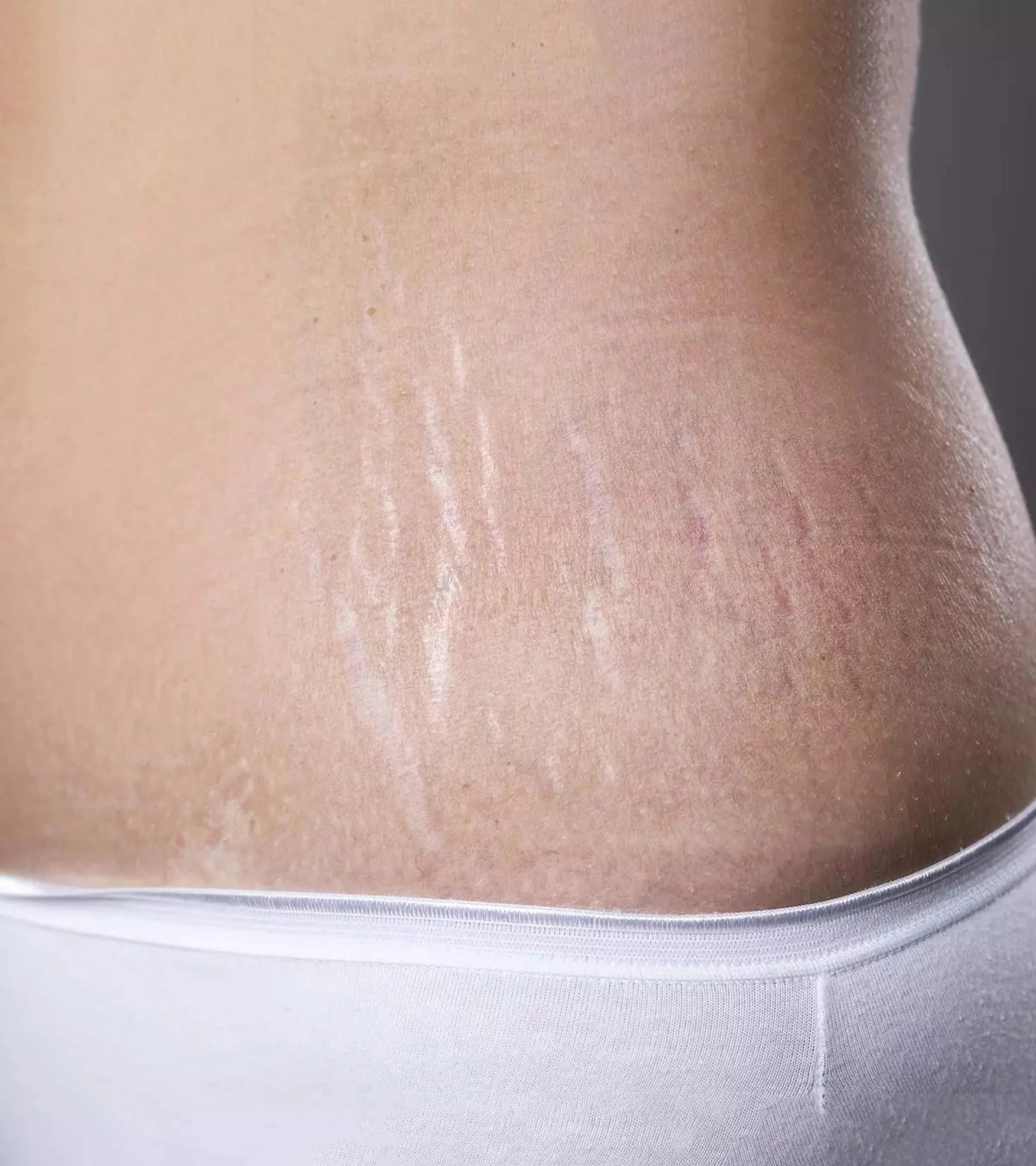 Laser Treatment for Stretch Marks: Advanced Solutions for Smooth and Even Skin