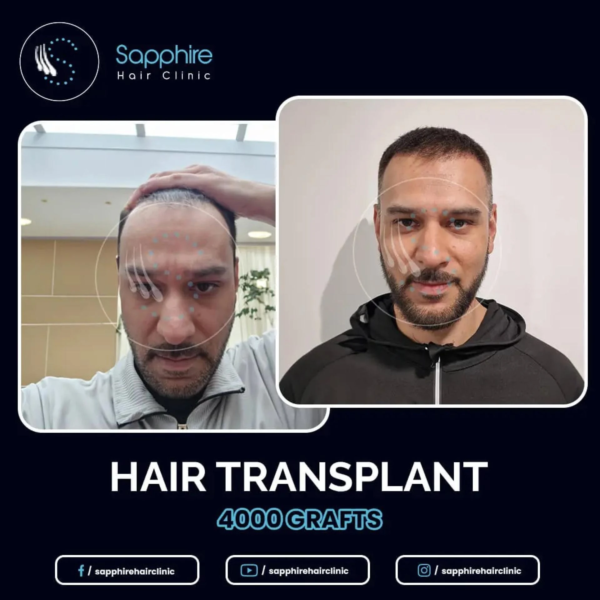 Hair Transplant Turkey: Natural Results and Long-Term Success