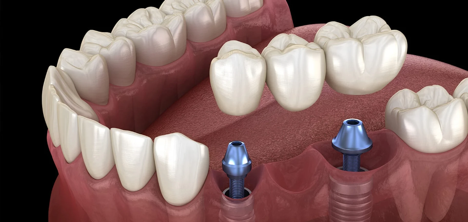 Getting Ready for Your New Smile: How to Mentally Prepare for Dental Implants