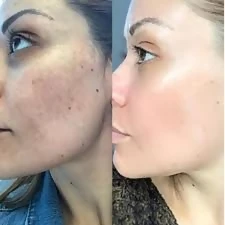 Cosmelan Pigmentation Treatment in Altrincham: Expected Results Timeline