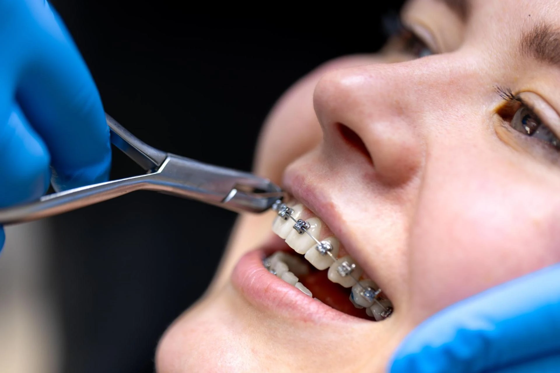 Best Dental Braces In RR Nagar Bangalore: Cost & Treatment Guide