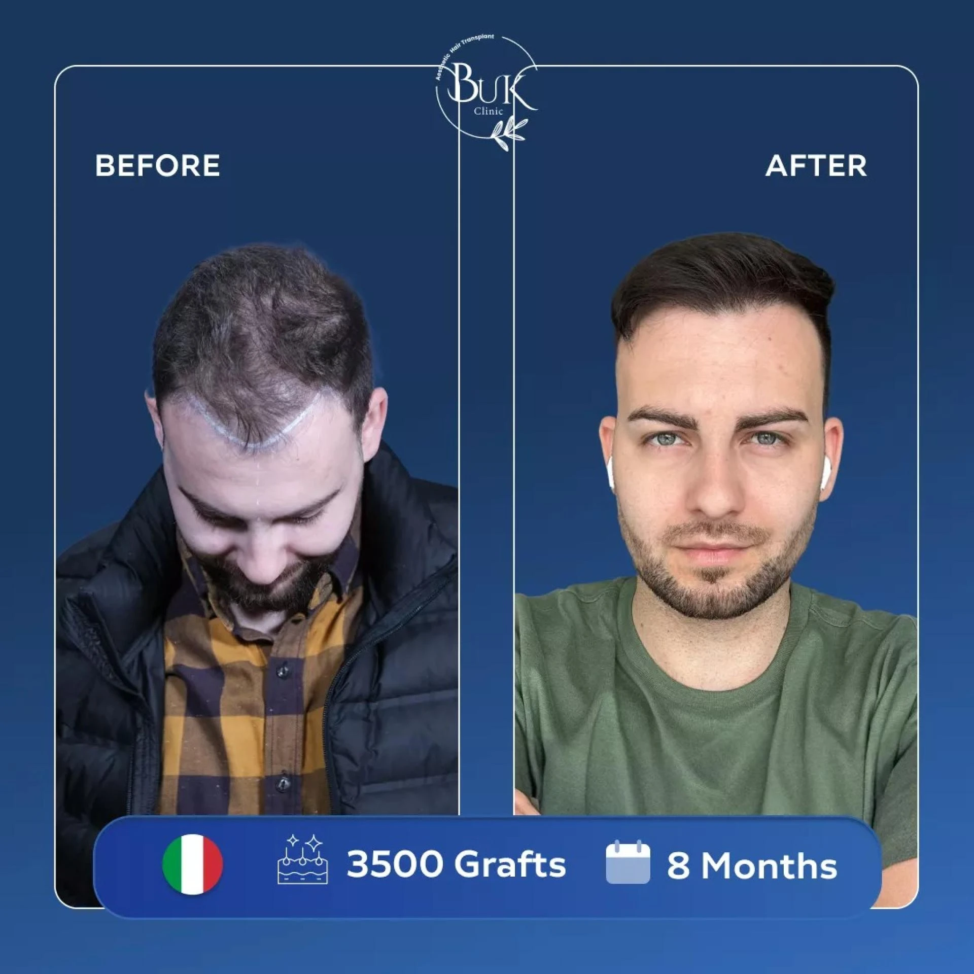 Hair Transplant Turkey Techniques: FUE and Modern Methods