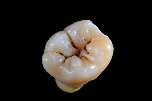 The Science Behind Dental Sealants and Cavity Prevention