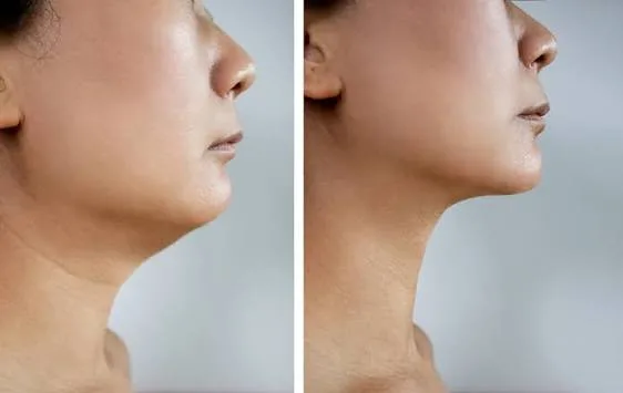 Redefine Your Profile with Safe and Modern Double Chin Reduction in Panvel