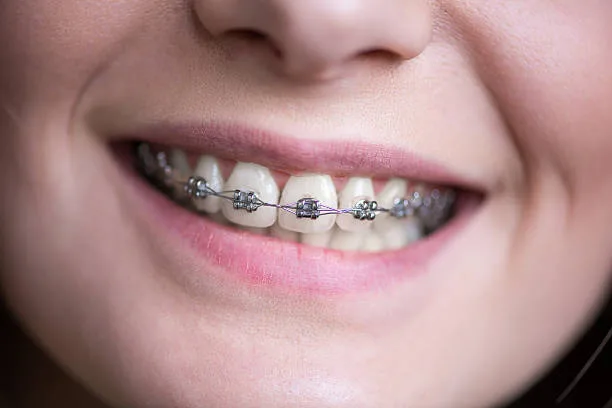 Trusted orthodontic care for a perfect smile transformation