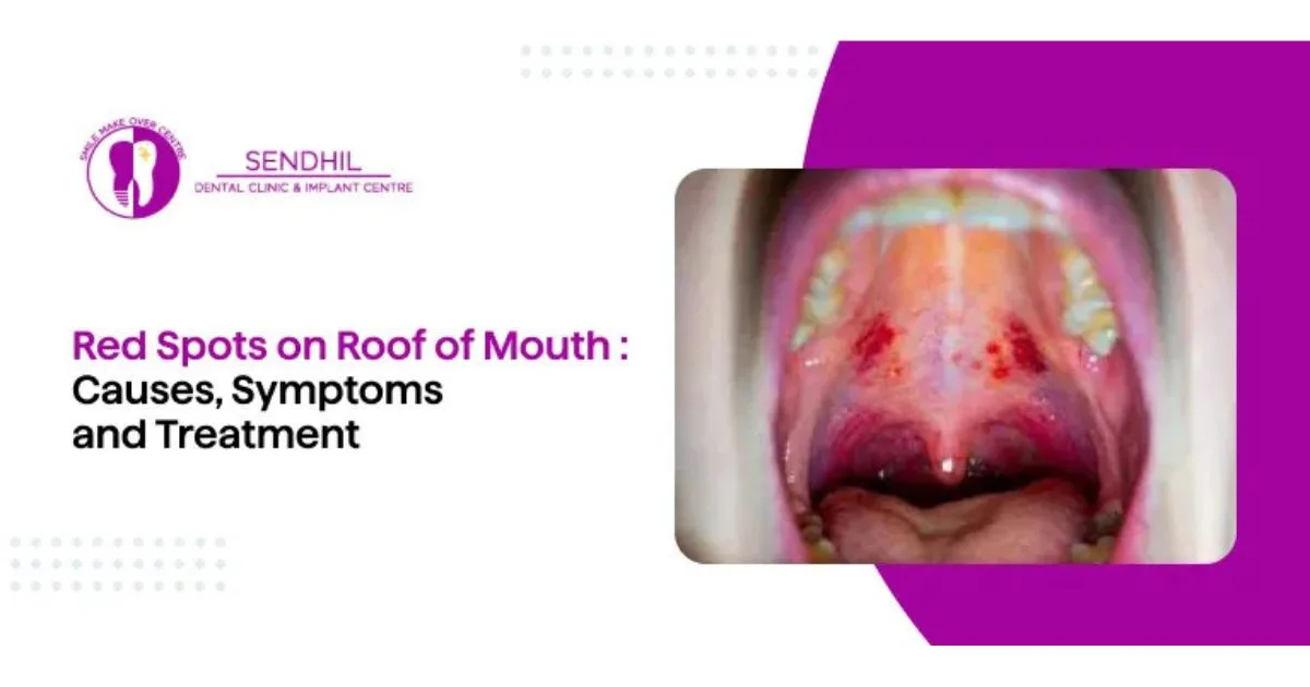 Red Spots on the Roof of the Mouth:   What Could They Mean?