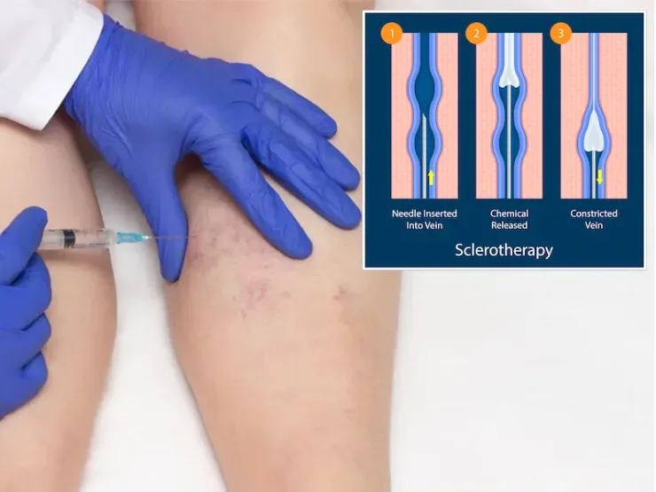 Endovascular Surgeon for Advanced Vein Care