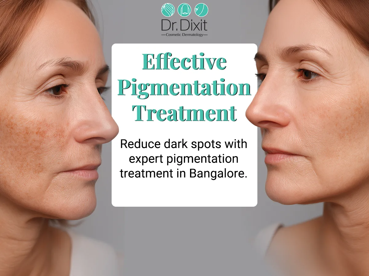 How Chrome Fractional Multi-Lens Array Treatment Helps Manage Pigmentation?